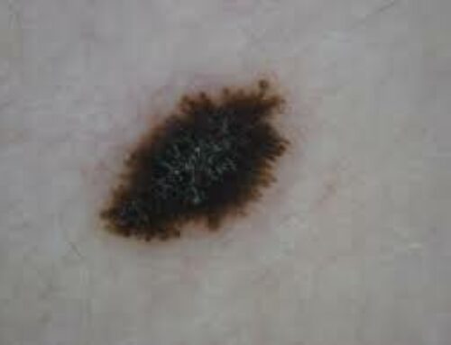 What is a Spitz nevus?
